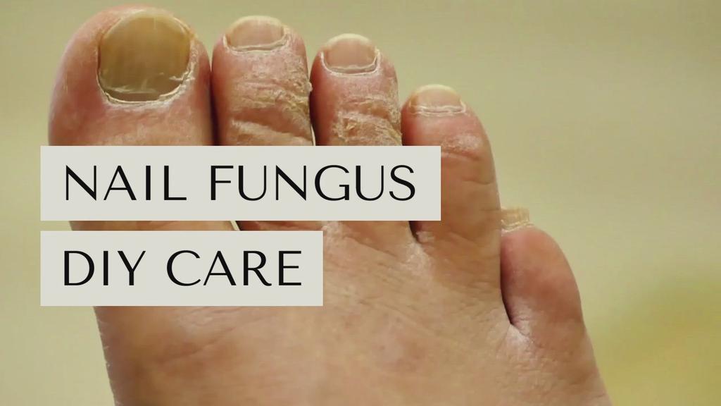 'Video thumbnail for Nail Fungus DIY Care'