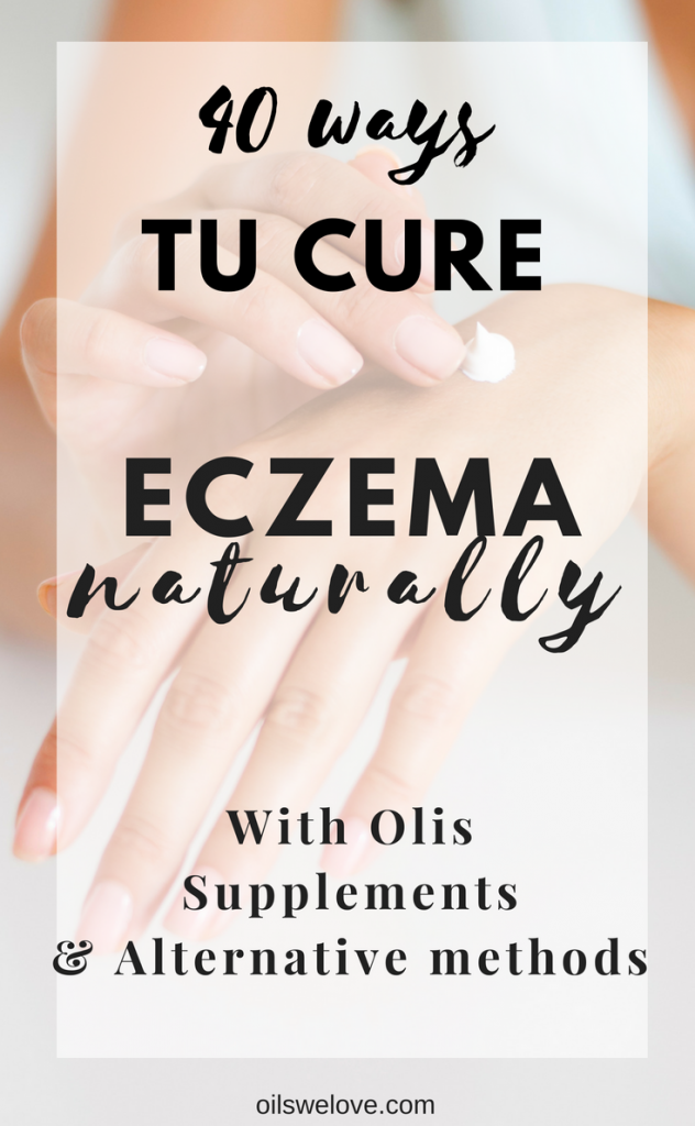 natural eczema treatments