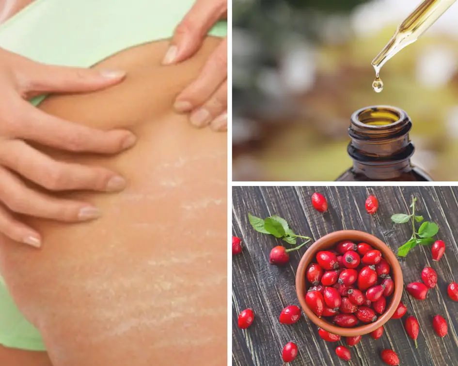 Rosehip oil for stretch Marks
