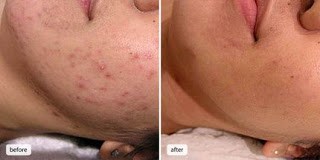 Evening-Primrose-Oil-Acne-Before-and-After-Picture-4
