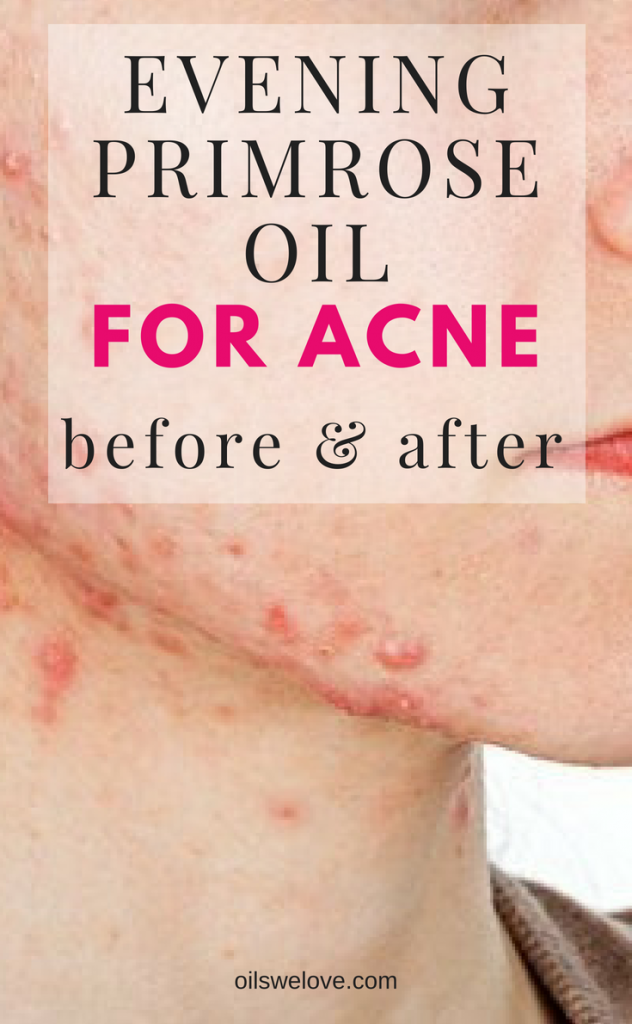 Evening Primrose Oil For Acne Before After Oils We Love