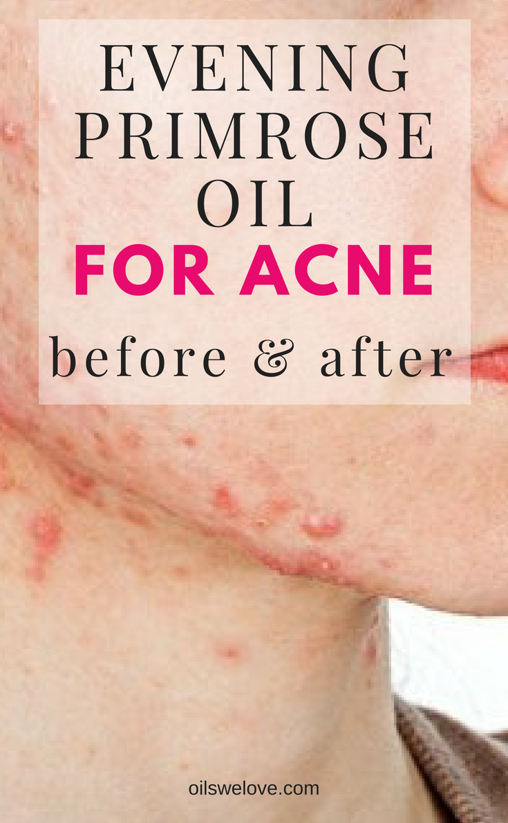 Evening Primrose Oil for Acne "Before & After" Oils we love