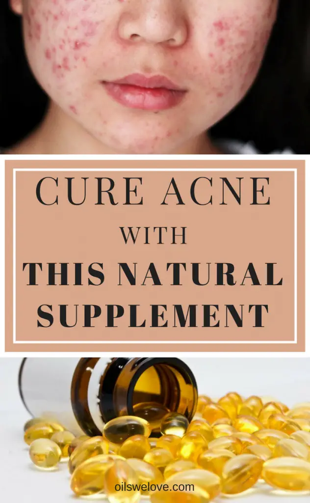 natural-acne-supplement-cure