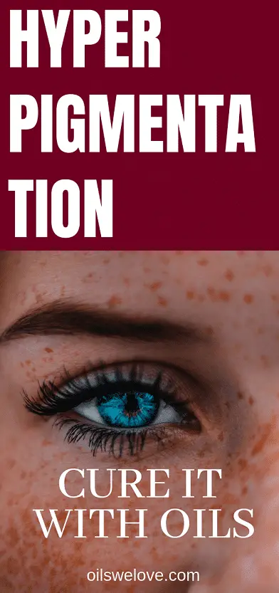 how-to-cure-hyperpigmentation